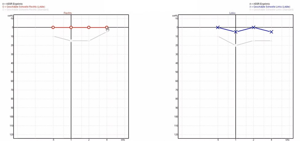 assr_audiogramm_detail_de.jpg