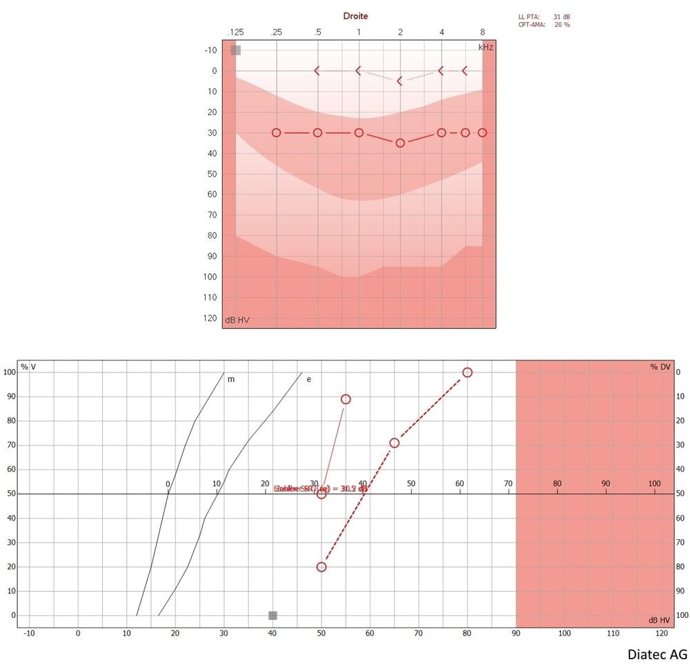 audiogramm_schallleitungsschwerhrigkeit_fr