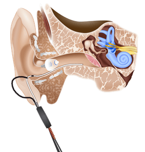 insitu_messung_ohr_versorgt