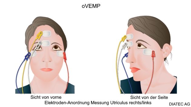 ovemp_elektrode_pos1_de_kl