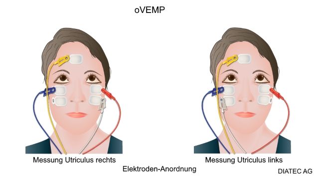 ovemp_elektrode_pos2_de_kl